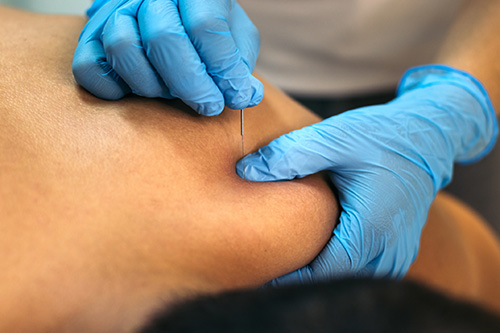 acupuncture needle going in skin